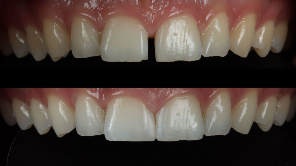 The Benefits of Composite Bonding Over Traditional Fillings in London