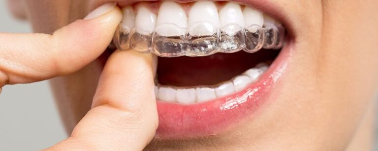 Achieving a Perfect Smile with Invisalign in Leicester